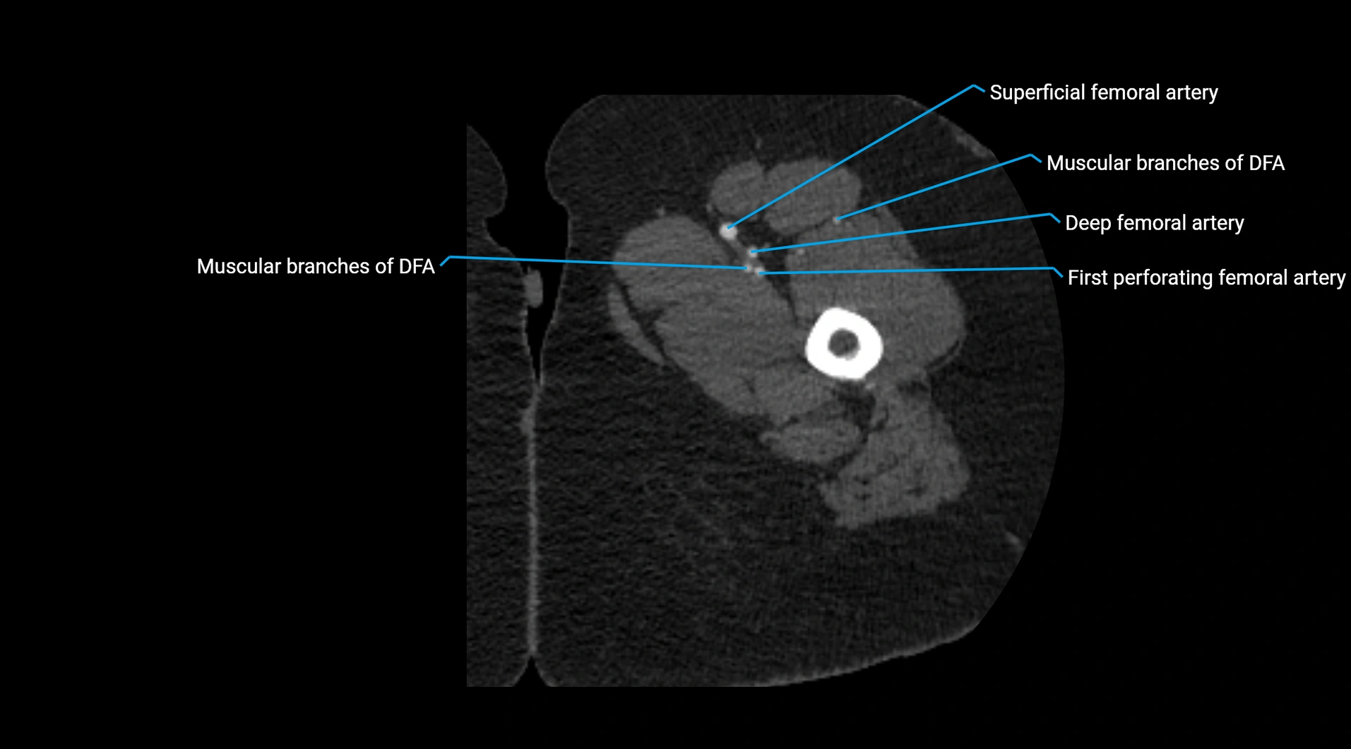 CTA lower limb cross sectional anatomy labelled image _88.webp